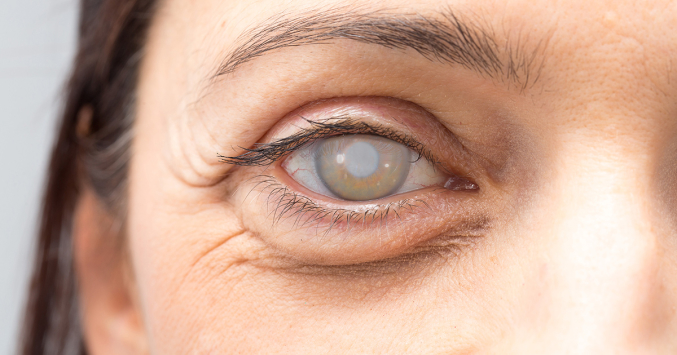 Understanding the Symptoms of Cataract